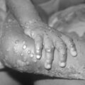 featured image Monkeypox pandemic fears as thousands infected with disease in just one Brazilian city